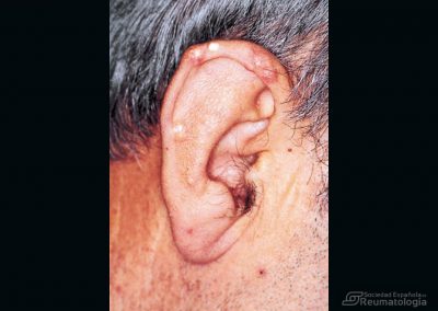 Artropatía microcristalina. Gota. Tofos en pabellón auricular.