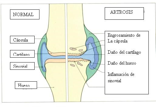http://www.artritisylupus.com/articulos_pacientes/artrosis.html