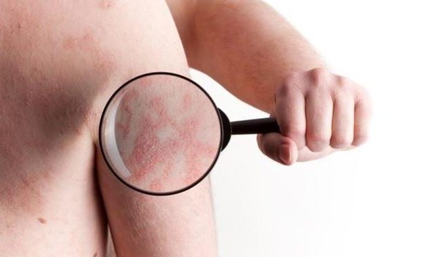 Cuando la psoriasis se vuelve artritis