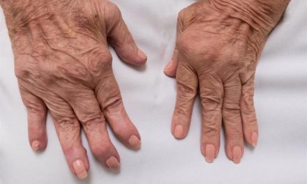Los pacientes con artritis psoriásica presentan con más frecuencia obesidad, uveítis y depresión