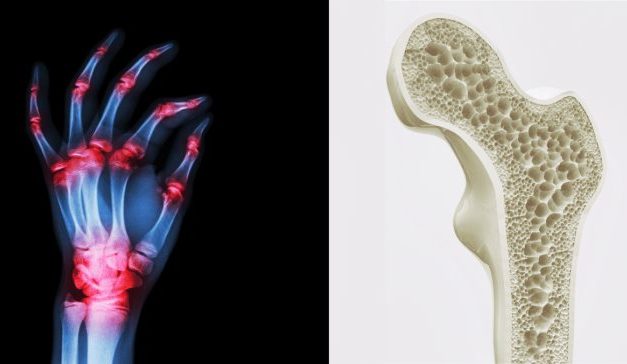 Datos claves sobre la relación entre artritis y osteoporosis