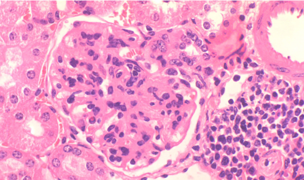 Investigadores españoles logran un prometedor avance en el abordaje del lupus eritematoso sistémico