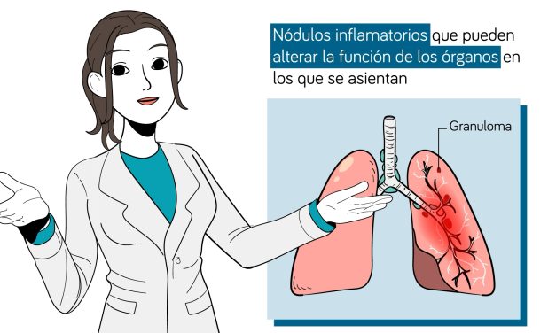 Pacientes y reumatólogos reclaman mayor visibilidad de la sarcoidosis para mejorar el diagnóstico precoz