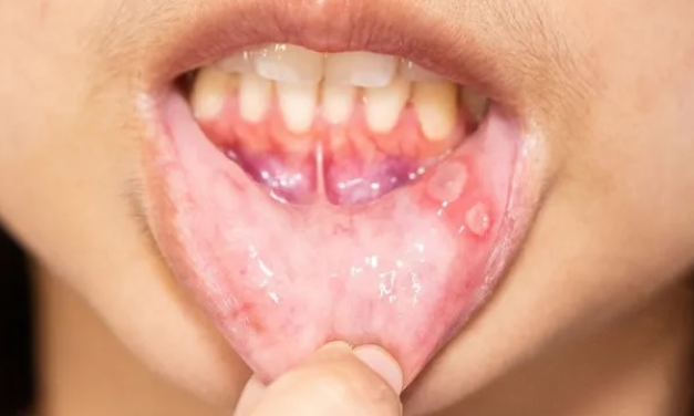 Día Internacional del Síndrome de Behçet: Una enfermedad rara que sigue pidiendo visibilidad