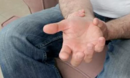 Nuevos tratamientos reducen el dolor y la discapacidad de la artritis reumatoide