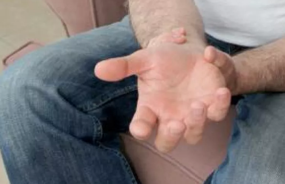 Nuevos tratamientos reducen el dolor y la discapacidad de la artritis reumatoide