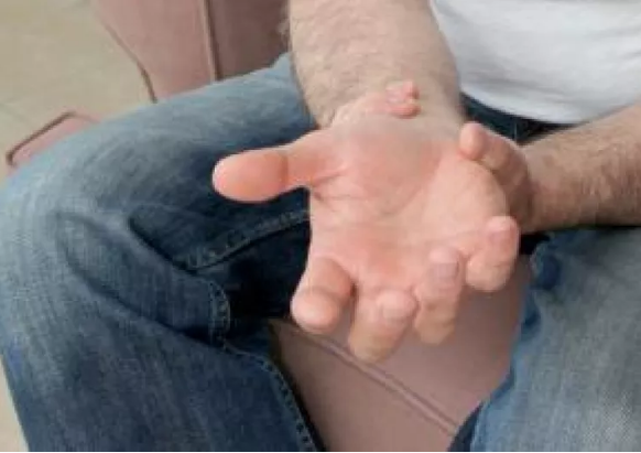 Nuevos tratamientos reducen el dolor y la discapacidad de la artritis reumatoide