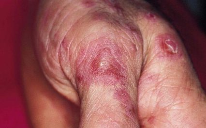 Síndrome de Behçet