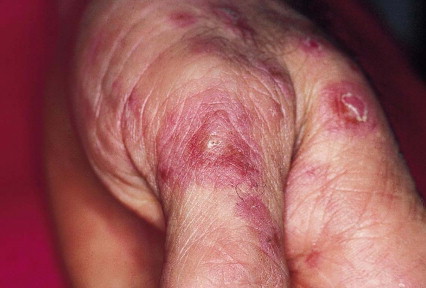 Síndrome de Behçet