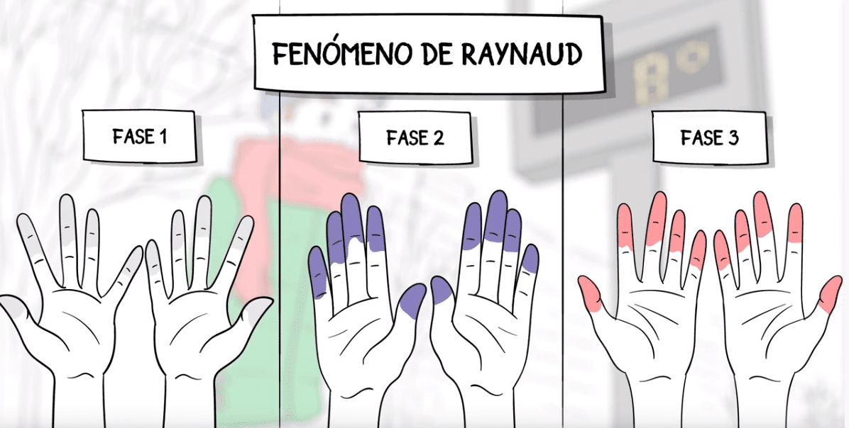 Fenómeno de Raynaud