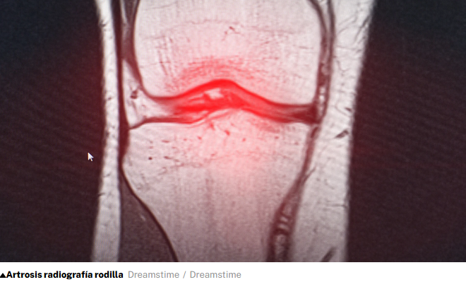 Un estudio revela que el ejercicio en casa es tan eficaz como la fisioterapia para aliviar el dolor de rodilla