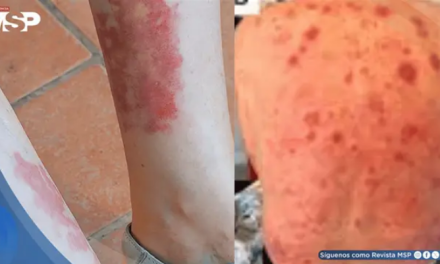 Síndrome VEXAS: expertos de la ACR establecen por primera vez criterios para su diagnóstico y manejo