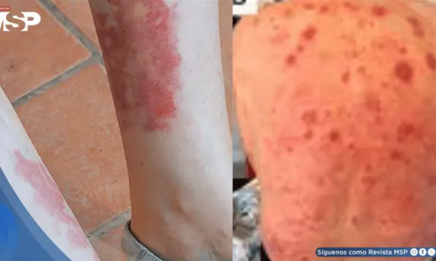 Síndrome VEXAS: expertos de la ACR establecen por primera vez criterios para su diagnóstico y manejo