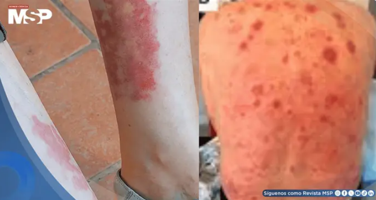 Síndrome VEXAS: expertos de la ACR establecen por primera vez criterios para su diagnóstico y manejo