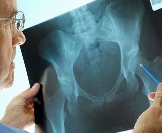 Osteoporosis: de los viejos mitos a los nuevos retos
