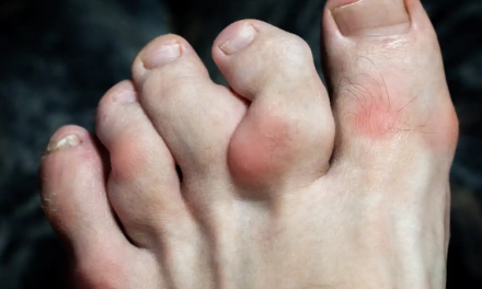 La vuelta de la enfermedad que mataba reyes: los diagnósticos de gota aumentan un 150% en el mundo en los últimos 30 años