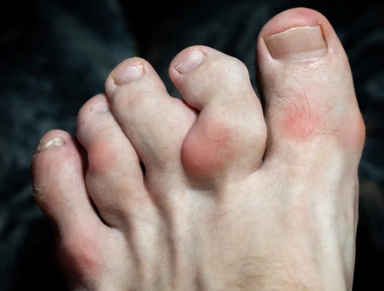 La vuelta de la enfermedad que mataba reyes: los diagnósticos de gota aumentan un 150% en el mundo en los últimos 30 años